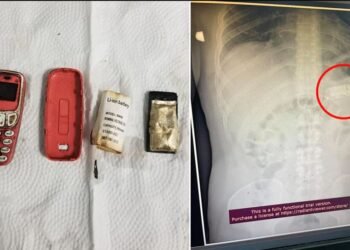 এজন লোকে খালে Nokia ফোন, পেটত গৈ এনেকুৱা কিবা এটা হ’ল; চিকিৎসকে X-Ray চাই হতবাক