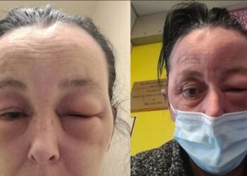 ‘চুলিত ৰং’ কৰি এই দুৰ্দশা মহিলাৰ; ফটো দেখি হয়টো আপুনিও ত্যাগ কৰিব Hair Dye