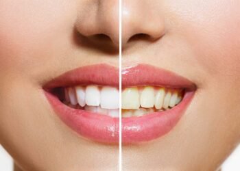 Health Tips: আপোনাৰ দাঁতৰ ৰং হালধীয়া নেকি? পাকঘৰতে আছে দাঁত বগা কৰাৰ উপায়, অনুসৰণ কৰক এই টিপছ্