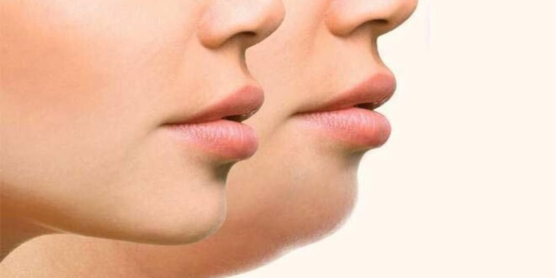 Health Tips: মুখৰ চৰ্বি (Face Fats) হ্ৰাস কৰিবলৈ কৰক এই কাম; আৰু অধিক ধুনীয়া হৈ উঠিব!