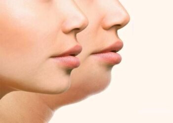 Health Tips: মুখৰ চৰ্বি (Face Fats) হ্ৰাস কৰিবলৈ কৰক এই কাম; আৰু অধিক ধুনীয়া হৈ উঠিব!