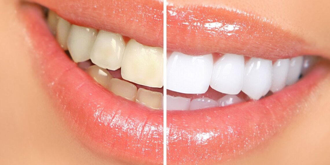 Health Tips: দাঁতক (Teeth) গাখীৰৰ দৰে বগা কৰিবলৈ গ্ৰহণ কৰক এই ঘৰুৱা প্ৰতিকাৰ, আহক জানো কি কি?