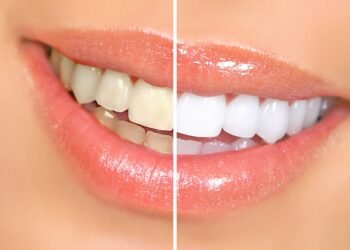 Health Tips: দাঁতক (Teeth) গাখীৰৰ দৰে বগা কৰিবলৈ গ্ৰহণ কৰক এই ঘৰুৱা প্ৰতিকাৰ, আহক জানো কি কি?