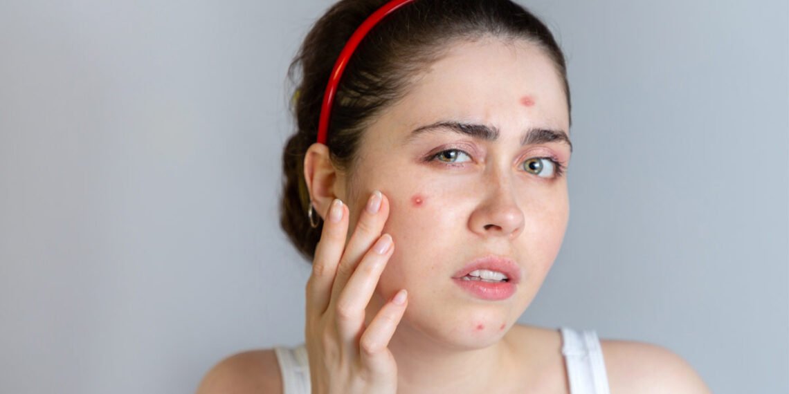 Health Tips: শালমইনা (Pimples)ৰ পৰিত্ৰাণ পাবলৈ খাওক এই কেইবিধ Herbal Drinks