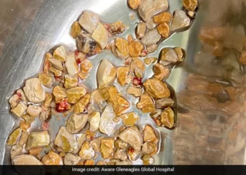 আচৰিত ঘটনা! এটা, দুটা নহয় একেলগে ২০৬টা পাথৰ (Kidney Stones) ওলাল এজন ৰোগীৰ কিডনীৰ পৰা; এঘণ্টা ধৰি চলিছিল অস্ত্ৰোপচাৰ
