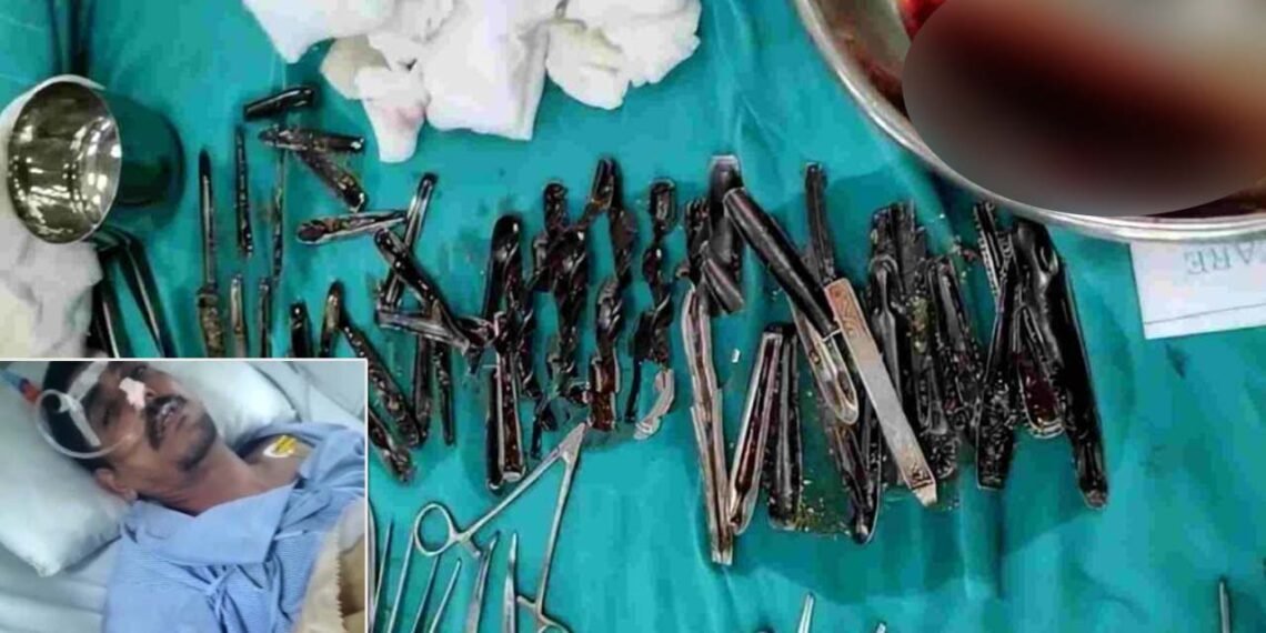 আজৱ! যুৱকৰ পেটৰ পৰা চিকিৎসকে উলিয়ালে ৬৩খন ষ্টীলৰ চামুচ (Spoons); দেখি চিকিৎসকো হৈ উঠিল আচৰিত, কিন্তু কেনেকৈ পেটত গ’ল ইমানকেইখন চামুচ?